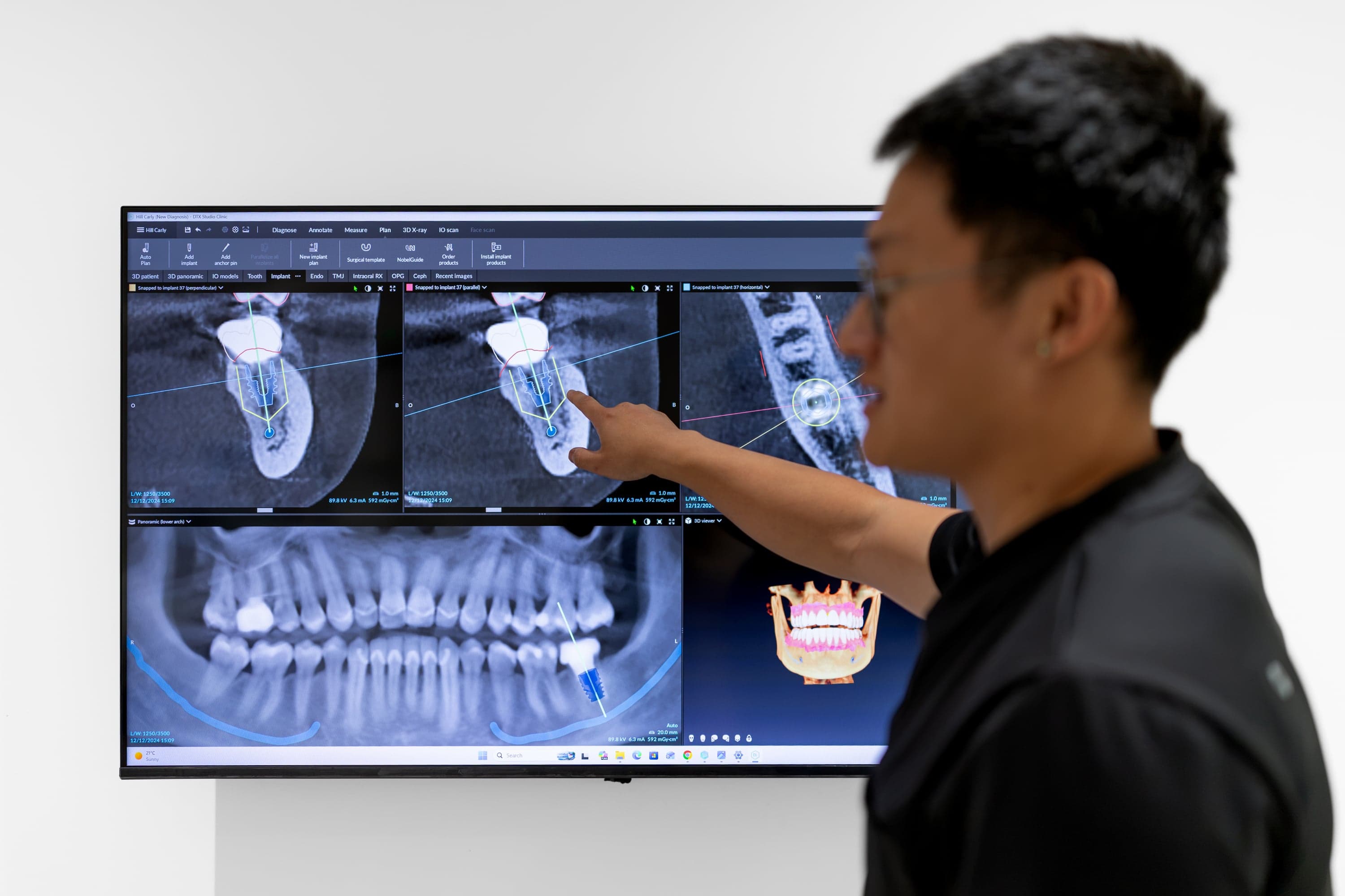 Dental Implants