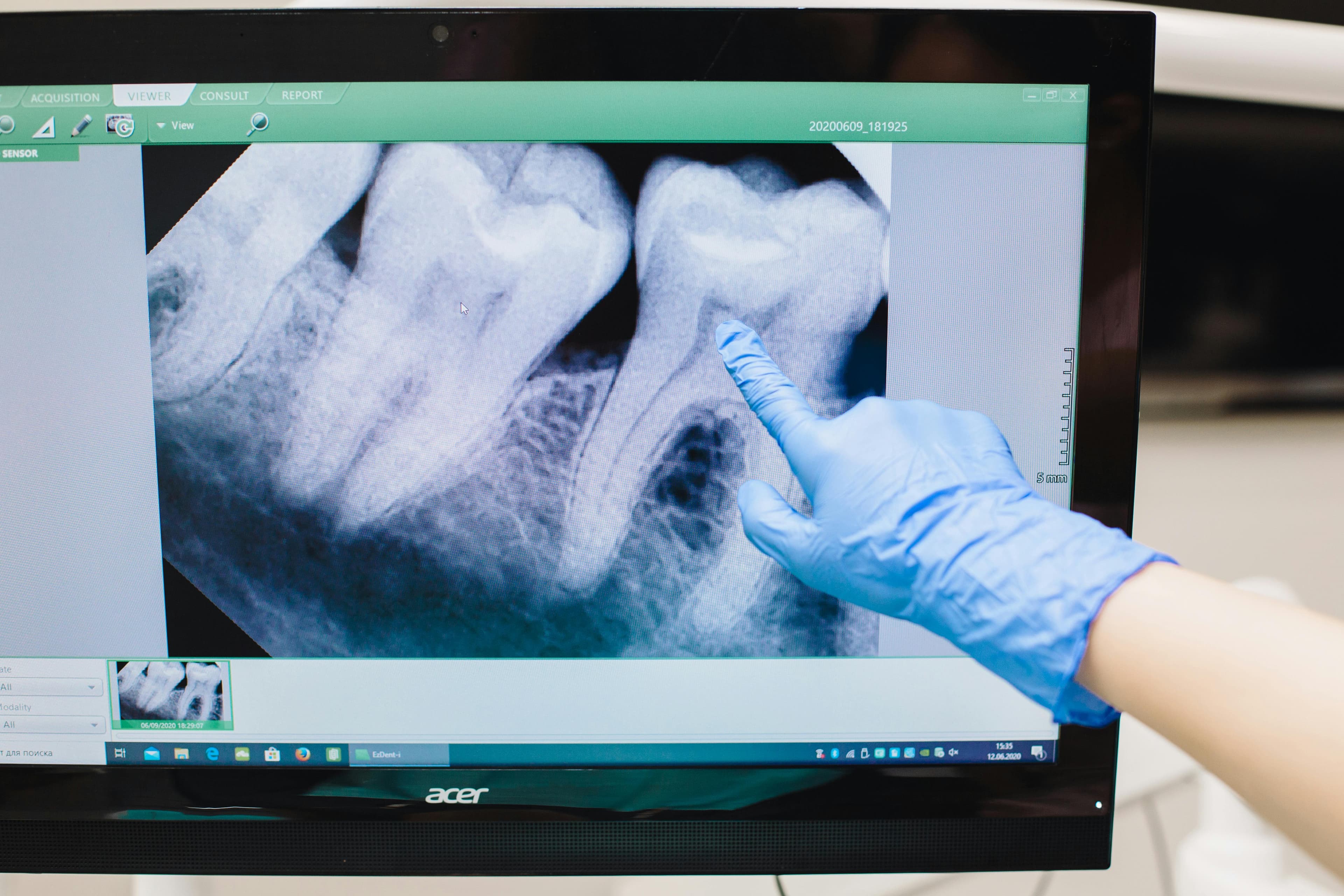 Root canal being sealed with biocompatible gutta-percha material